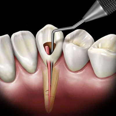 Endodoncia Dental La Merced