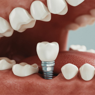 Implantes Dental La Merced