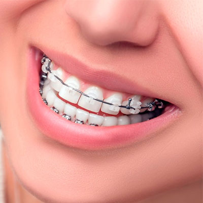 Ortodoncia Brackets Dental La Merced