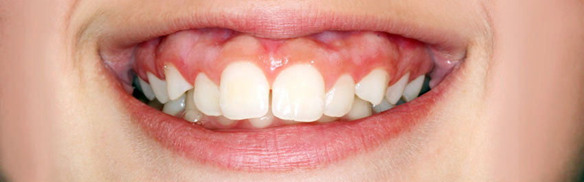 Antes Ortodoncia Dental La Merced